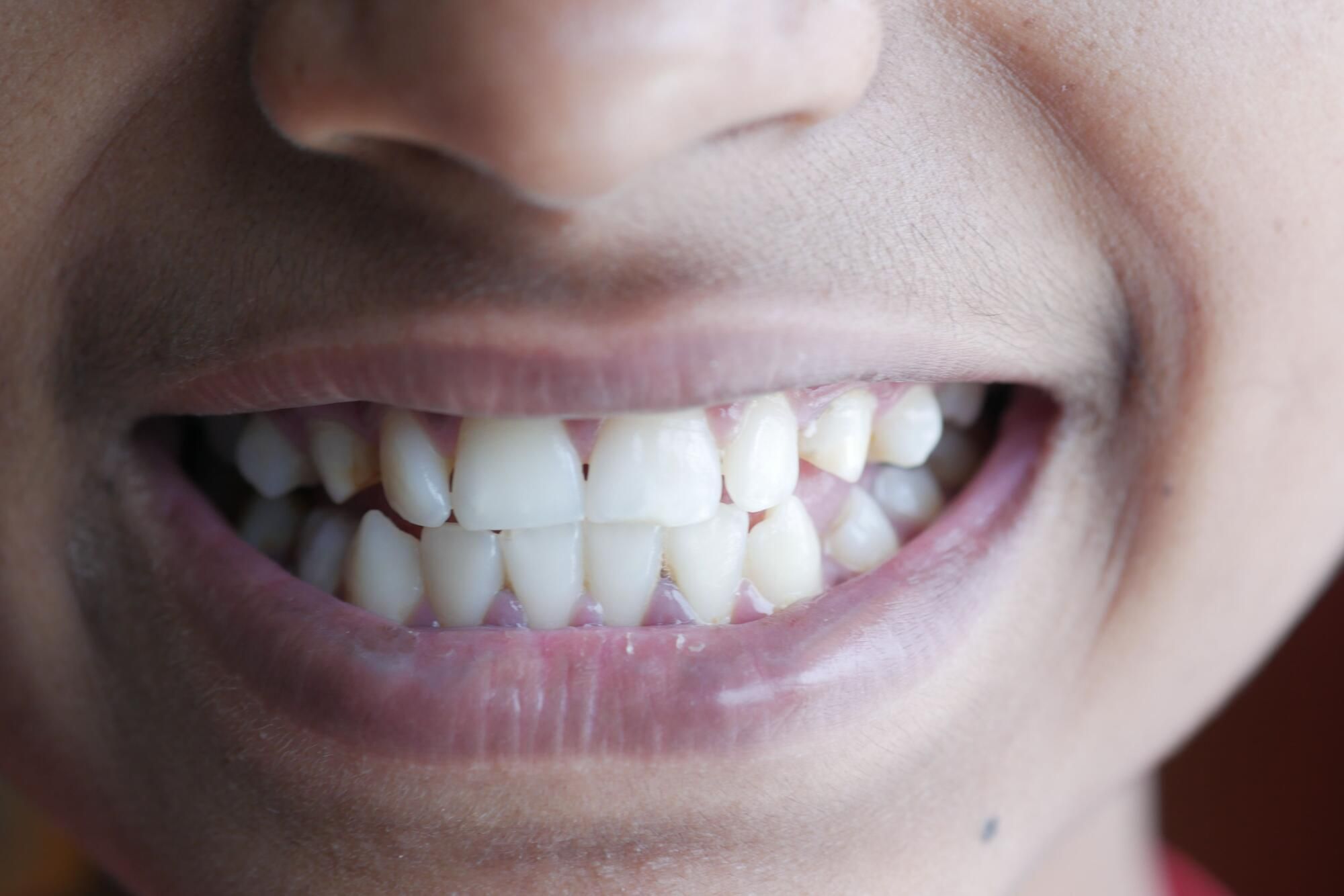 Tooth movement doesn't stop after adolescence